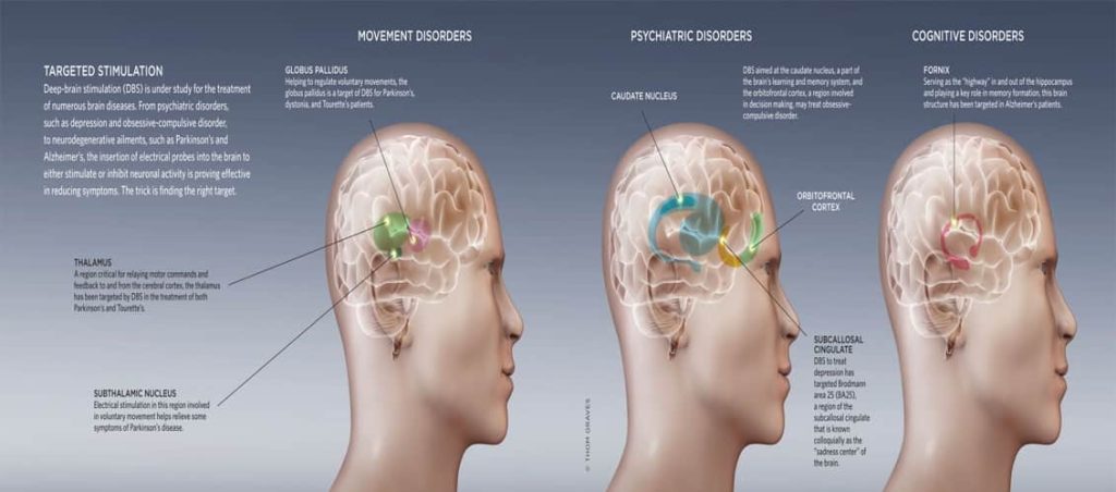 Estudio de estimulación cerebral FIDMAG